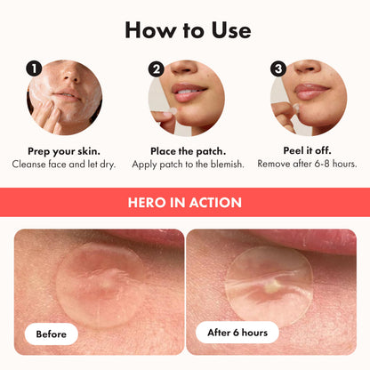 Hero Cosmetics Mighty Patch Original – Hydrocolloid Patch for Pimples, Overnight Acne Blemish & Zit Stickers for Sensitive Skin, 36 Count 🍁 All In One Marketplace Canada